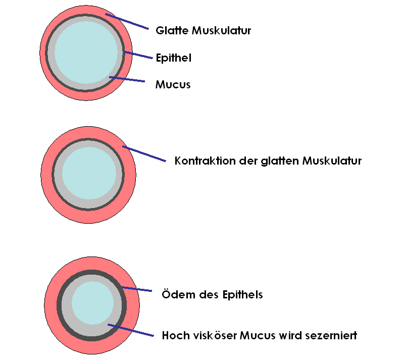 Verengung der Bronchiolen, Dsypnoe. Aufgrund von Reizen in der Atemluft (Kälte, Allergene, Staub) wird die glatte Muskulatur spontan angespannt.