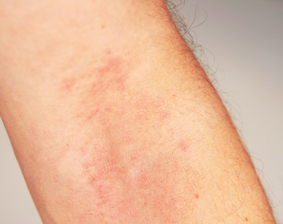 Beugenekzem bei atopischer Dermatitis [Altmeyer P und Bacharach-Buhles 2015]