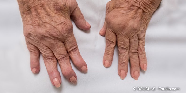 Gibt es einen Zusammenhang zwischen rheumatoider Arthritis und Allergien?