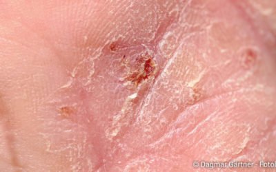 Informationsveranstaltung zu Psoriasis, Neurodermitis und Allergien