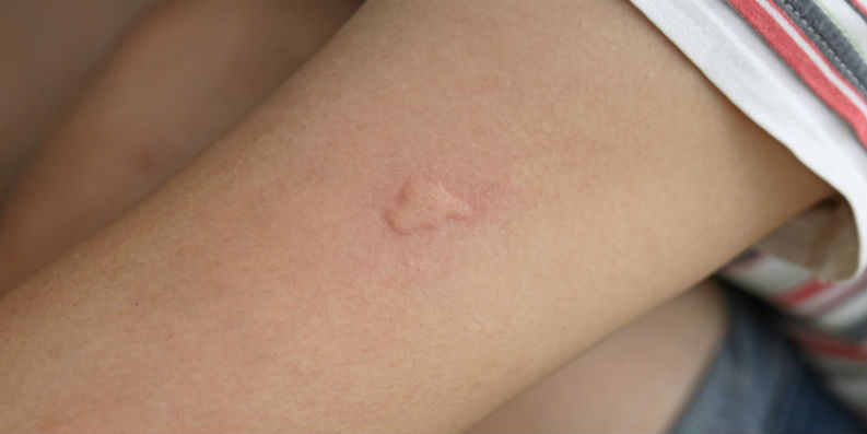 Nesselsucht: Schwere allergische Symptome bei Frühlingskindern